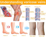 Charger l'image dans la galerie, Bee Venom Varicose Veins Spray
