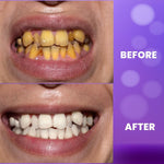 Charger l'image dans la galerie, BloomBright™ Purple Teeth Whitening Gel
