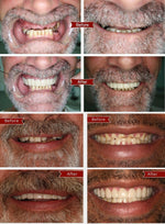 Charger l'image dans la galerie, Ezysmyl™️ Snap-On Dentures
